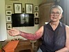 Ei eldre kvinne viser fram ein raud underarm i ei stove.